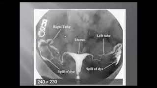 How to read and understand Hysterosalpingography