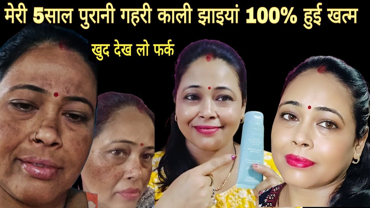 मेरी 5 साल पुरानी गहरी काली झाइयां हुई जड़ से खत्म सिर्फ कुछ दिनों में! pigmentation hatane ki cream