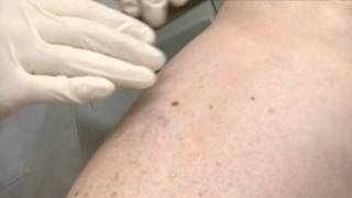 Roswell Park Expert Weighs in on Melanoma Cancer Vaccine