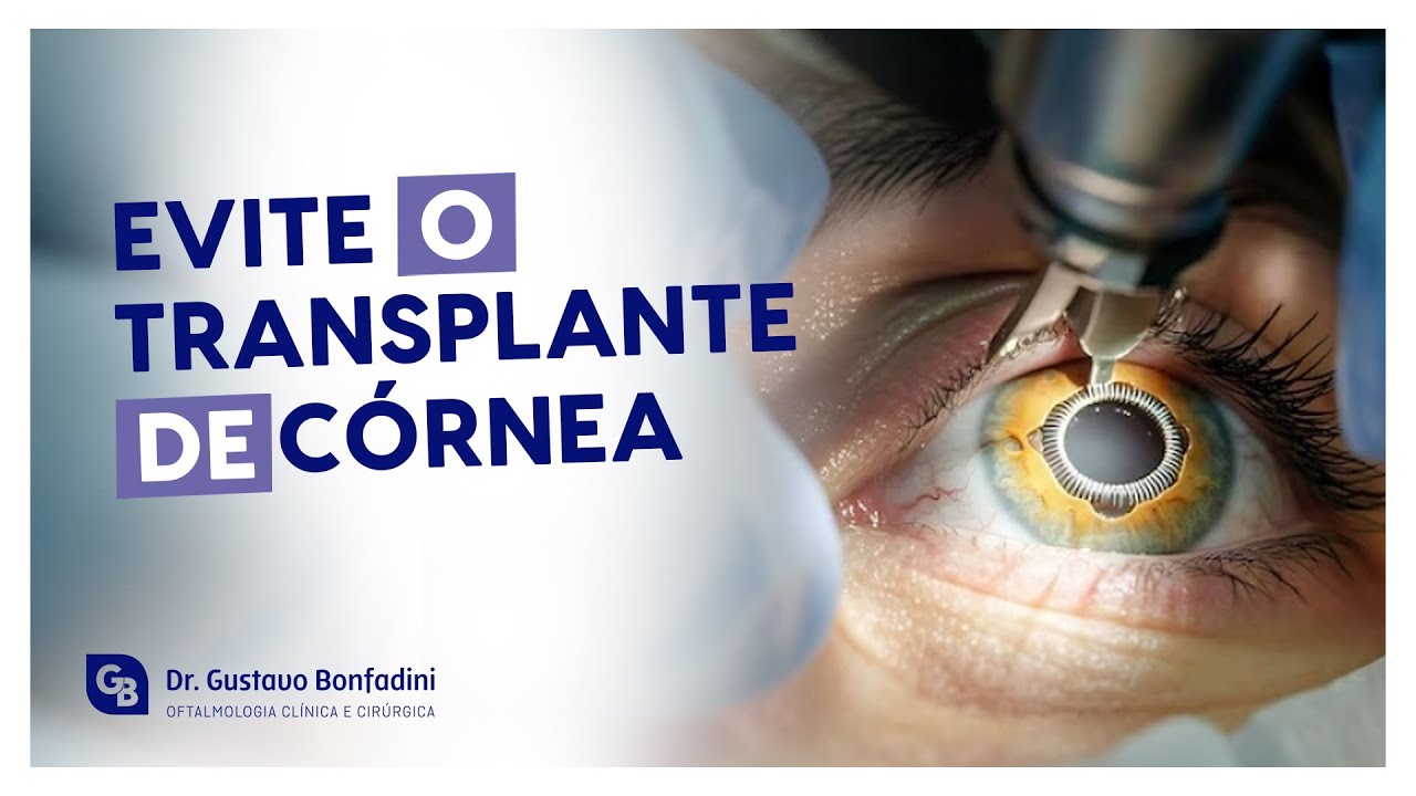 COMO O ANEL DE FERRARA AJUDA A FREAR O CERATOCONE (E EVITAR O TRANSPLANTE)