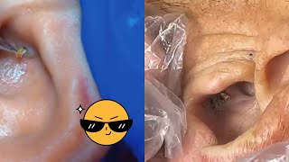 Ultimate Ear Blackheads Removal: Satisfying Extraction Compilation!