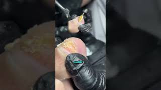 Nadie habla de esto: los hongos en las uñas son una infección