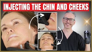 Injection Techniques Dermal Filler Chin & Cheek Tutorial