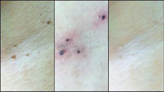 How To Remove Warts At Home DIY - Cashew / Kasoy Oil Review How To Remove Warts At Home DIY - Cashew / Kasoy Oil Review