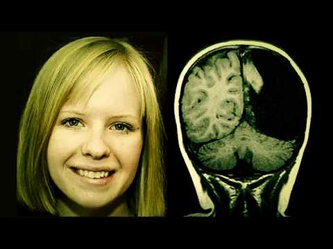A Normal Life With Half a Brain thumbnail