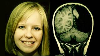 A Normal Life With Half a Brain