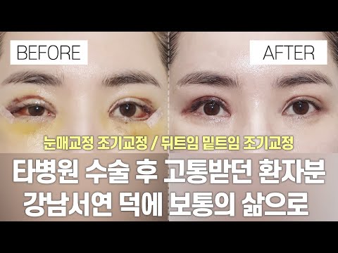 눈 성형 전후 |  타병원 수술 실패 후 고통받던 환자분 강남서연에서 조기교정했어요!