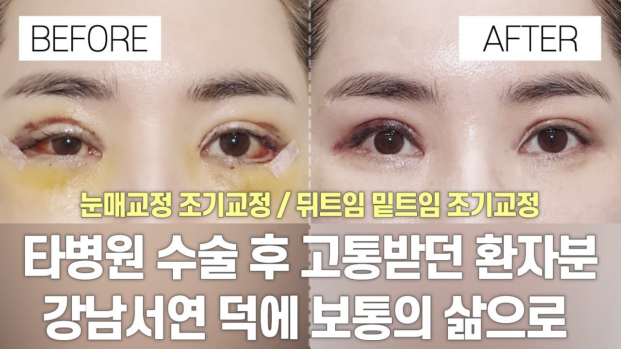 [Ганнам Соёон гоо сайхны мэс заслын эмнэлэг] Нүдний гоо сайхны мэс засал - Өмнө ба дараа | Өөр эмнэлэгт амжилтгүй хийгдсэн мэс заслын дараа зовж шаналж байсан өвчтөнийг Ганнам Соёон эмнэлэгт эрт засаж залрууллаа!