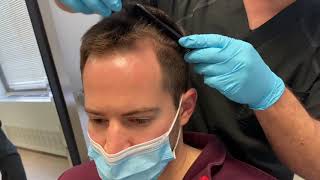 Fort Lauderdale Hair Transplant Clinic | Permanent Hair Restoration