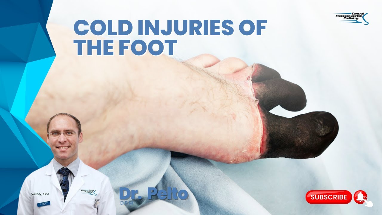 Cold Intolerance Foot Cold injuries of the foot - YouTube
