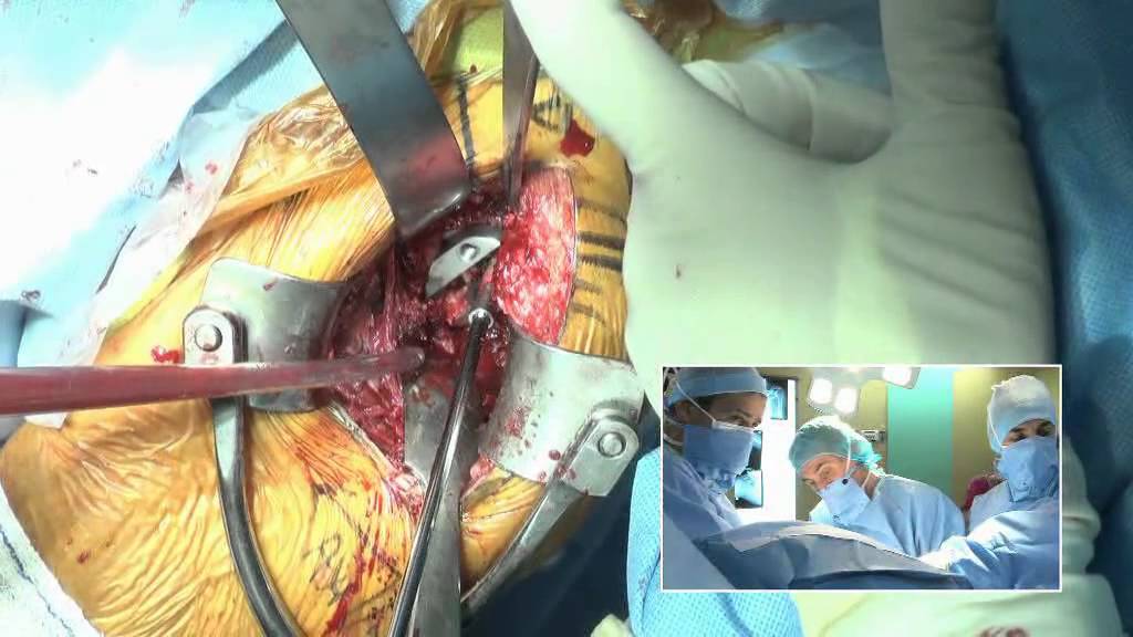 FH Orthopedics, Inc. Arrow Reverse Shoulder, Paris Intl Shoulder Course. Dr. Philippe Valenti 2013 camera iphone 8 plus apk