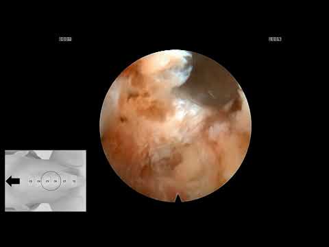 Video: Undersökning Av Sagittal Anpassning Och Kliniska Resultat Efter På Varandra Följande Tre-nivå Hybrid Kirurgi Och Anterior Cervical Discectomy Och Fusion: Minst En 5-årig Uppföljnin