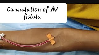 Cannulation of AV fistula, HOW to cannulate new  AV fistula? 