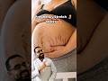 Pregnancy stretch 🤰 marks 🤩 #pregnancystretchmarks, #stretchmarks, #pregnancyskincare