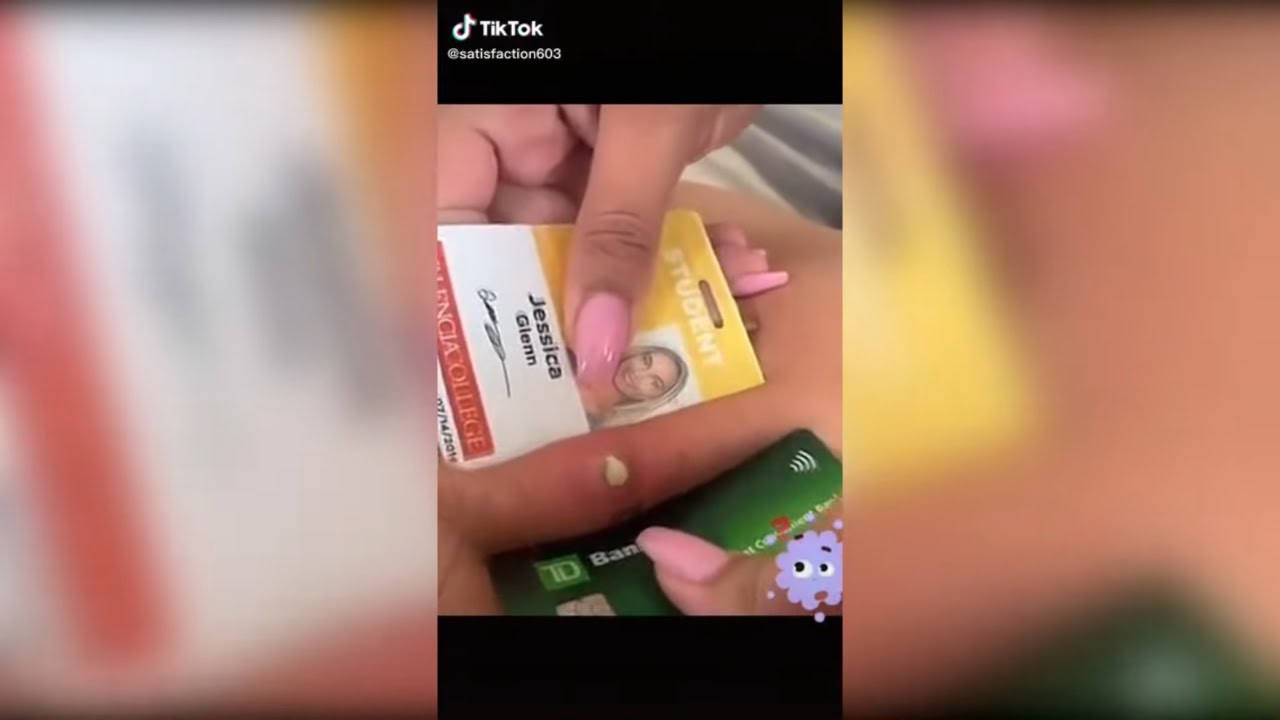 Popping huge blackheads and Pimple Popping - Best Pimple Popping Videos 72