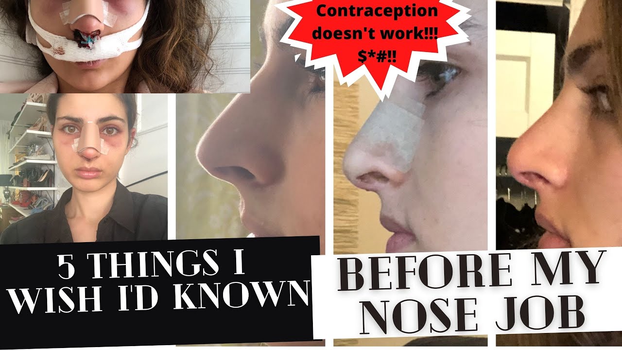 NOSE JOB 5 Things I wish I'd known before getting a nose job I