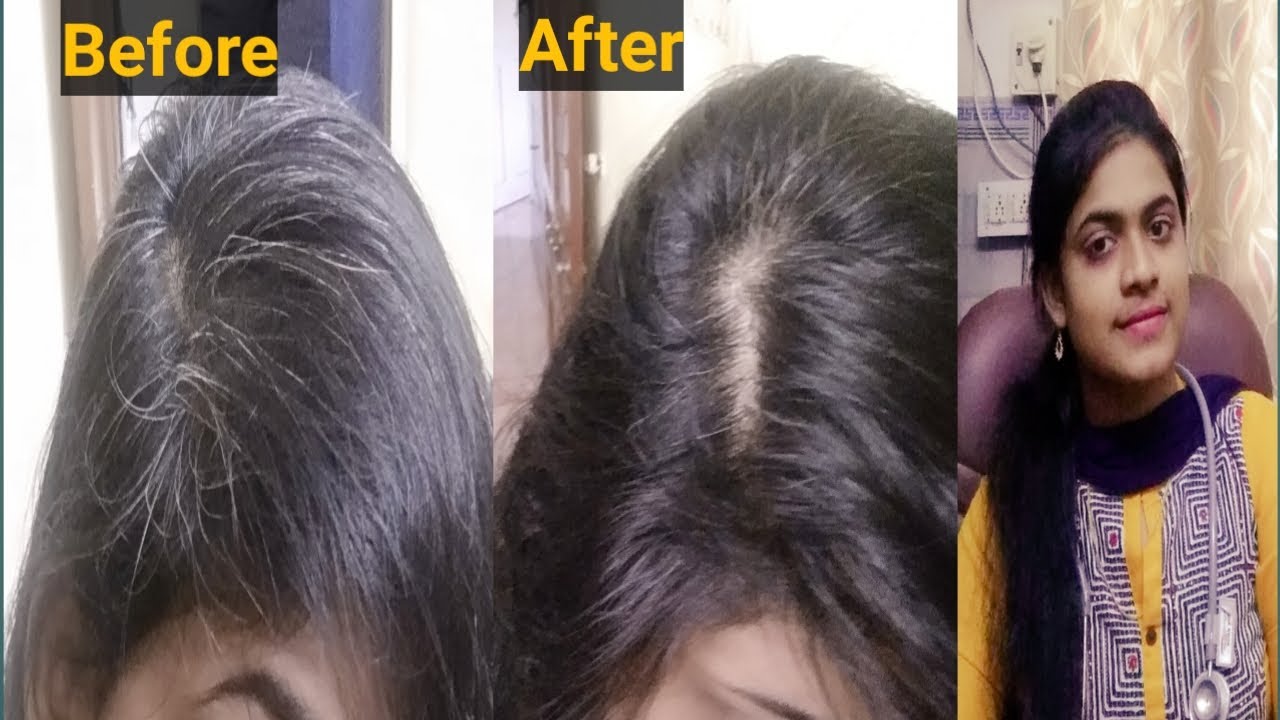 இளநரைக்கு நிரந்தர தீர்வு || Dr. Joyselin - JOY HOMOEO CARE