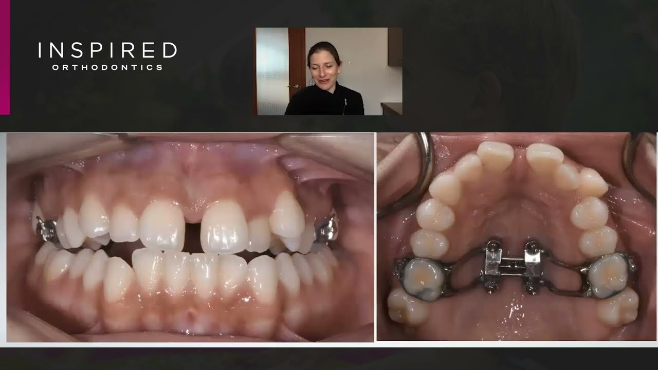 Non-Surgical Adult Expansion | Dr. Rebecca Bockow