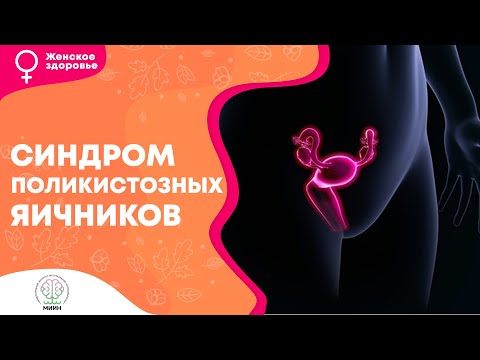 Женское здоровье || Синдром поликистозных яичников. СПКЯ признаки, диагностика, типы.
