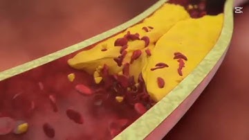 Recognizing a Heart Attack__ 3D Animation Video.