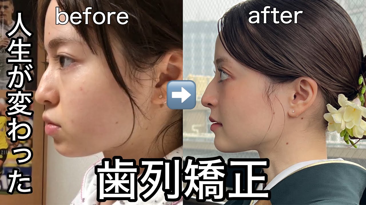 歯列矯正で顔が変わった女によるお話（後悔していることも🥲）