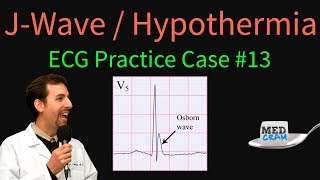 ECG Interpretation Practice: Hypothermia and The J Wave / Osborn Wave