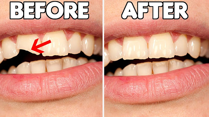 How To FIX A Chipped Tooth (Broken Tooth Repair Options)
