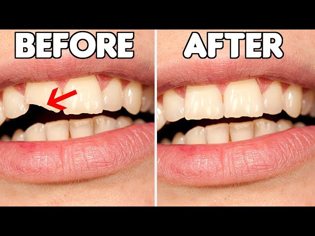 Chipped Tooth Repair in North Atlanta