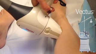 Vectus Laser - A Melhor Depilação do Mercado!