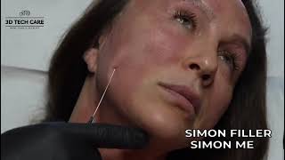 How Non Surgical FaceLift Works  Dr.Hüseyin Tirman Clinic