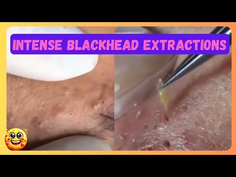nasty-blackheads-removal:-disgusting-cysts,-dark-skin-lesions