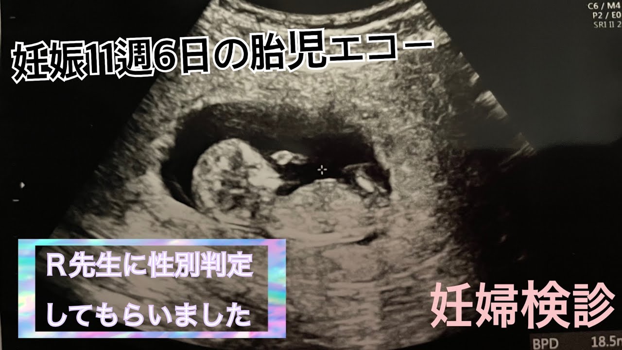 妊娠3ヶ月 妊娠11週6日の妊婦検診 胎児エコー ｒ先生性別判定 ベビーナブ Youtube