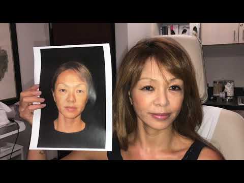 Facelift Diaries