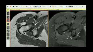 Systematic interpretation of Hip MRI - How I do it