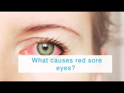 Video: Hva betyr såre øyeepler?