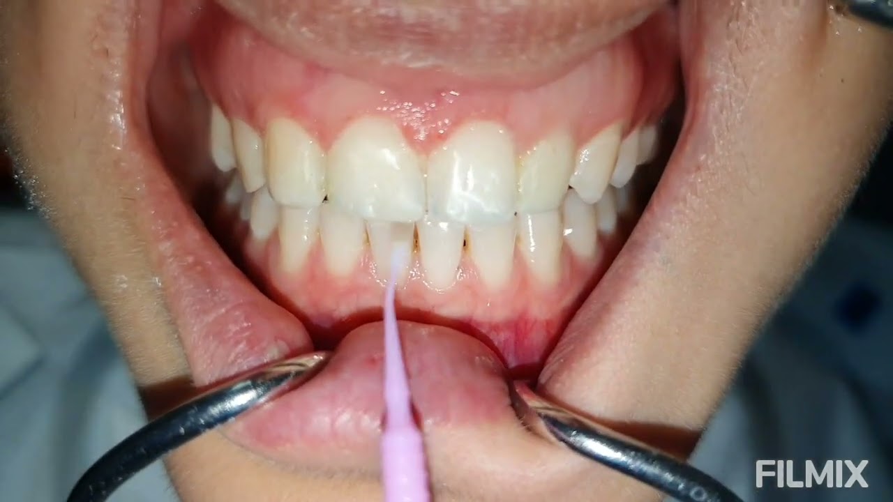 Düşmemiş süt dişi ve küçük lateral dişi buyutme tek diş eksikliği aralık diş tedavisi fiberle