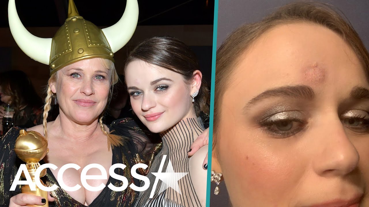 Joey King Sports Nasty Bruise After Patricia Arquette Accidentally Hits Her Head With Golden Globe