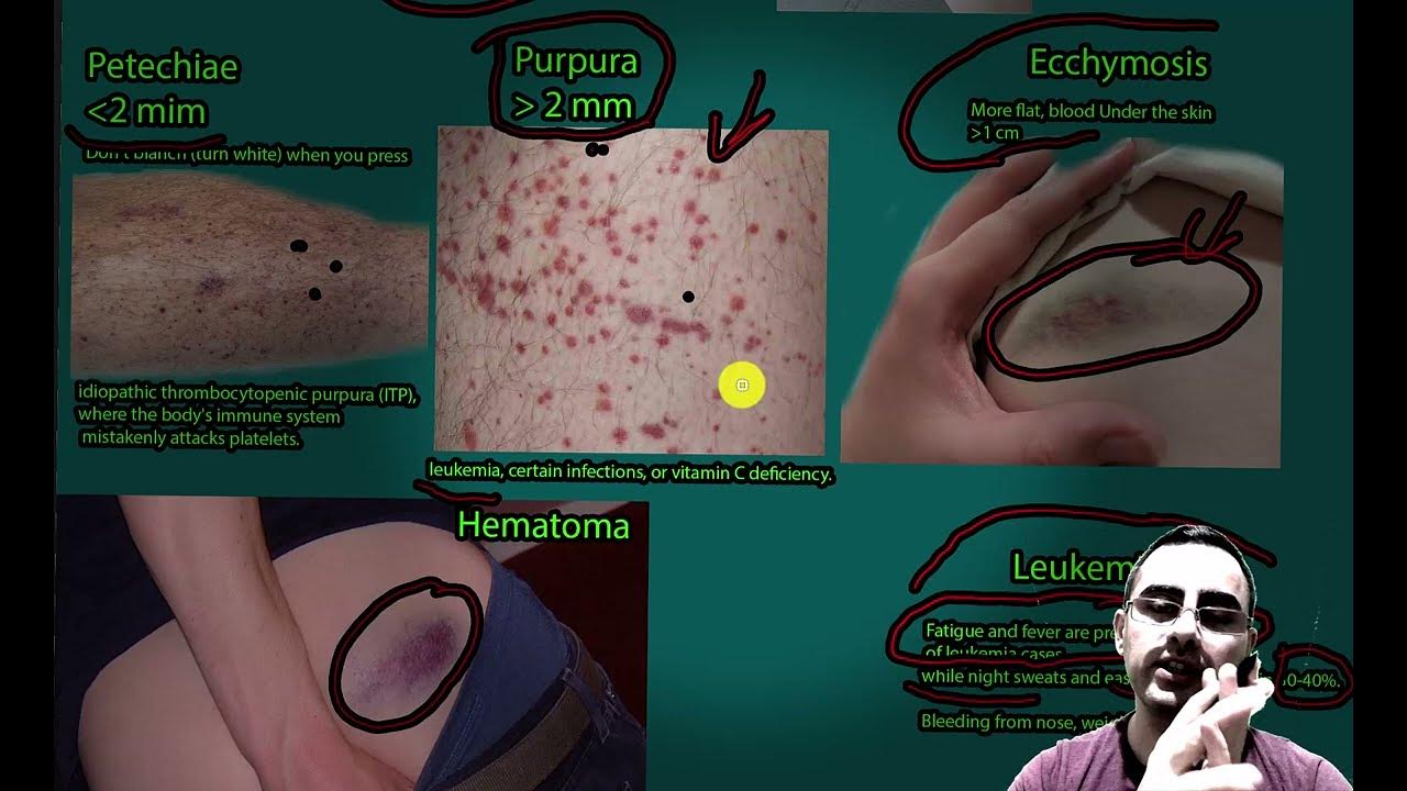 easy-bruising-from-simple-bumps-to-leukemia-signs-youtube