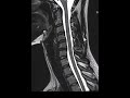 How to read and MRI of the cervical spine