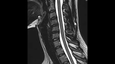 How to read and MRI of the cervical spine | First Look MRI