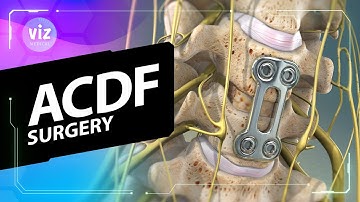 Anterieure cervicale discectomie en fusie (3D-animatie)