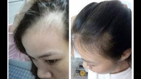 Trị TÓC RỤNG SỚM, HÓI ĐẦU NẶNG của GS Trương Việt BìnhI Tổng Đài Tư Vấn Trực Tiếp 0937.83.4444