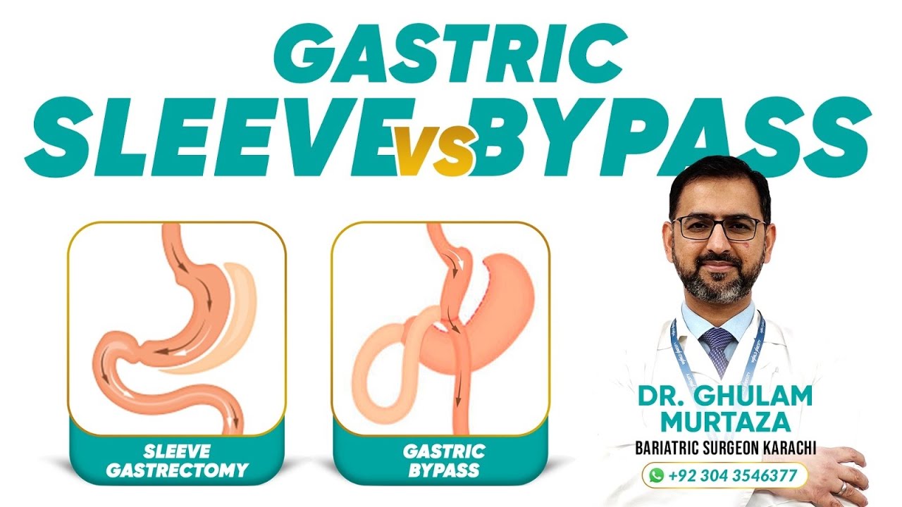 sleeve or bypassConfusion for patients before bariatric surgeryآخر