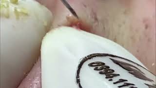 Satisfying Video | Removal Blackheads #4 With Relaxing music