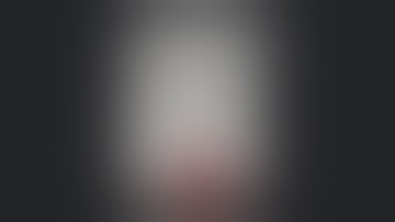 Revision Rotator Cuff Repair Augmented With AlloSync™ Pure Demineralized Bone Matrix