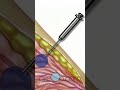 Understanding Breast Needle Biopsy 🎗️ What You Need to Know! #PreOp #Shorts Patient Education pt 3