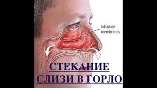 картинка: Почему стекает слизь по горлу? Лечение синдрома постназального затекания.