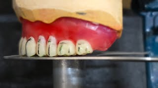 Arranging the artificial teeth for a complete denture within the occlusal plane, part 3:lower  poste