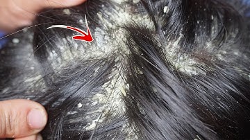 Dandruff Shampoo and Scratching, Itchy Dry Scalp, Huge Flake - Psoriasis #44