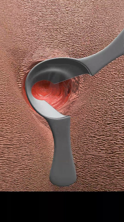 Why Do I Need Fistula Surgery? #shorts #fistula